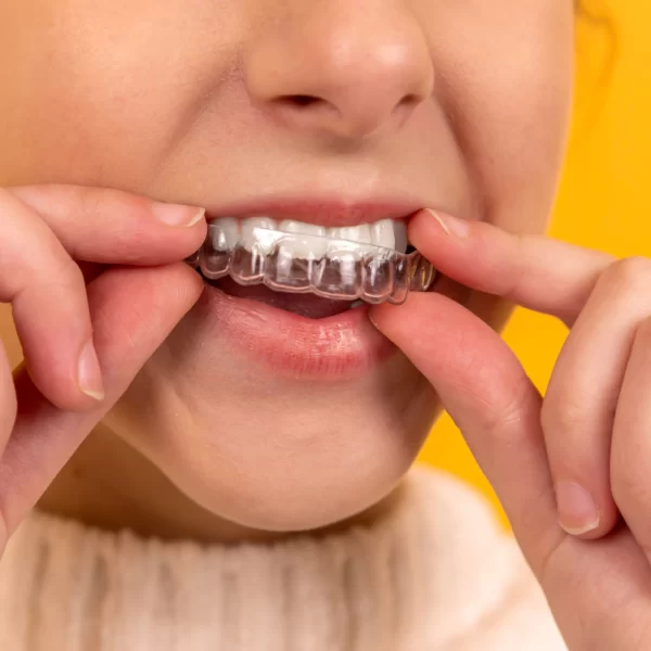 Il bite: a cosa serve?